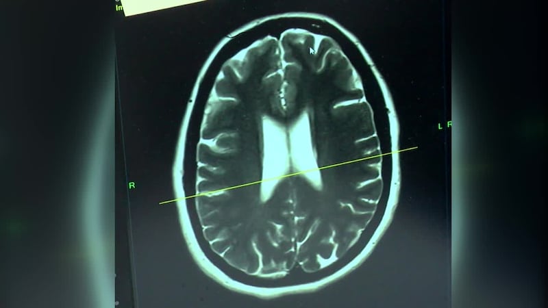 Alrededor de 5.8 millones de personas mayores de 65 años viven con la enfermedad de Alzheimer...